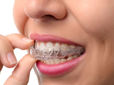 Amaltas Dental   Implant Center | Pediatric Dentistry, Oral Exams and Invisalign reg 