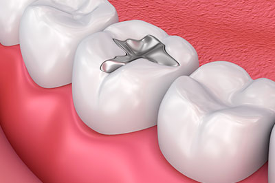 Amaltas Dental   Implant Center | Sleep Apnea, Crowns  amp  Caps and Teeth Whitening