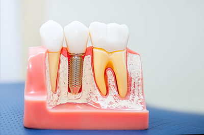 Amaltas Dental   Implant Center | Night Guards, Teeth Whitening and Crowns  amp  Caps