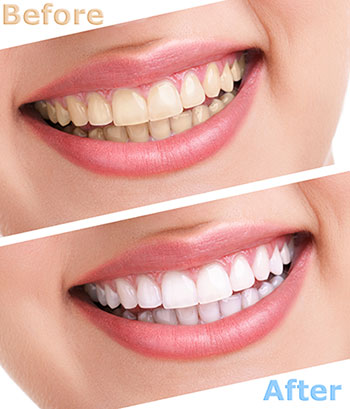 Amaltas Dental   Implant Center | Dental Bridges, Extractions and Invisalign reg 